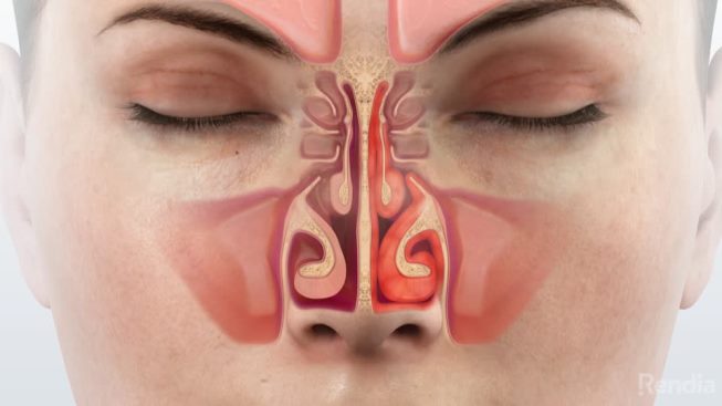Viêm mũi là một hiện tượng kích thích gây viêm màng nhầy bên trong mũi