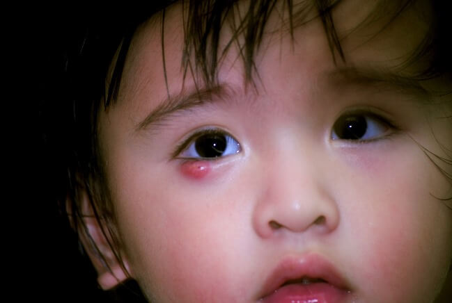 Đau mắt ở trẻ nhỏ là một bệnh nguy hiểm