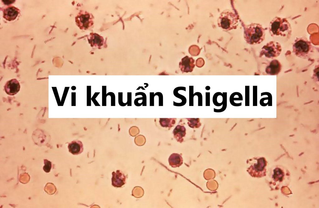 Nguyên nhân, triệu chứng và cách phòng ngừa khuẩn ShigellaNguyên nhân, triệu chứng và cách phòng ngừa khuẩn Shigella