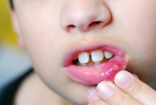 Nhiệt miệng: nguyên nhân và cách phòng và chữa trị nhiệt miệng tại nhà